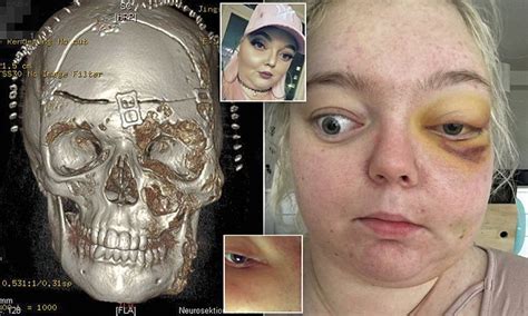 Authoritative facts from dermnet new zealand. WHAT IS MCCUNE ALBRIGHT SYNDROME? | Daily Mail Online