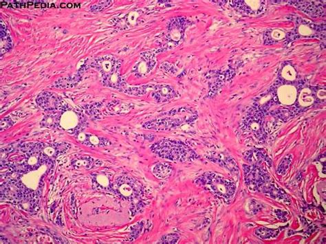 Histopathology Images Of Invasive Ductal Carcinoma Nos By Pathpedia
