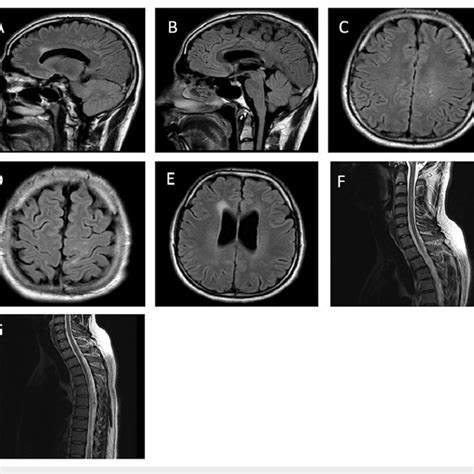 Mri Brain And Spinal Cord A B Sagittal View Of Brain Mri Flair