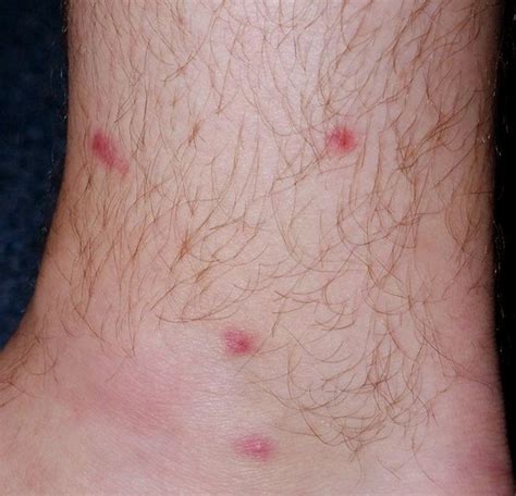 Red Spots On Legs Pictures Symptoms Causes Treatment Healthmd