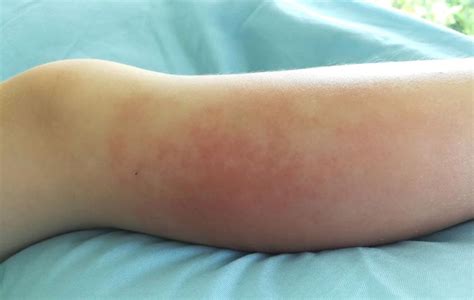 10 Signs And Symptoms Of Staph Infection You Need To Know