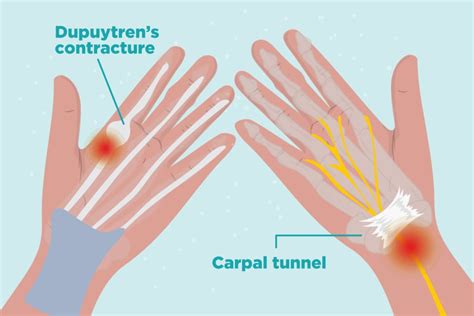 Arthritis In Hands Symptoms Types Of Hand Arthritis And Treatment