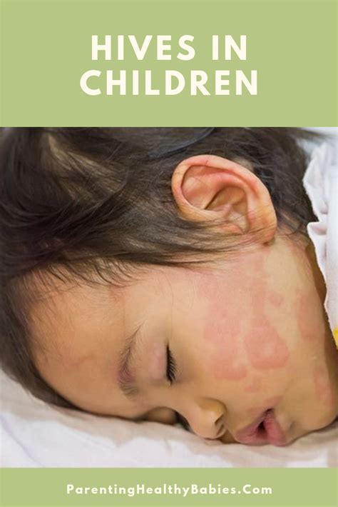 11 Home Remedies For Hives In Children Home Remedies For Hives Hives