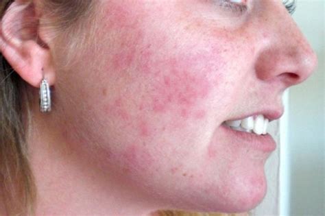 A Symptom Of Sensitivity Face Rash Remedies Rashes Remedies Rash On