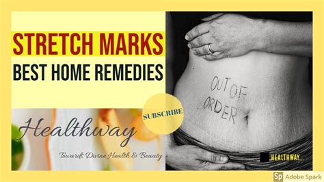 Best Home Remedies For Stretch Marks Youtube