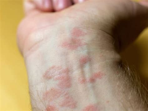 Tiny Red Spots On Skin Bumps Itchy Non Itchy Causes Get Rid Treatment