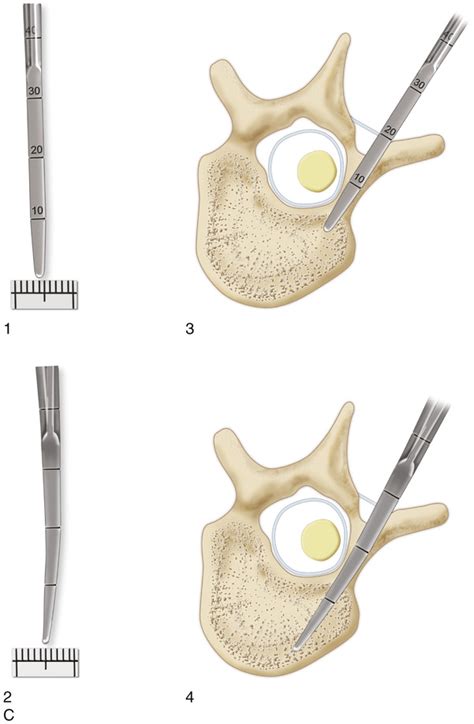40 Posterior Spinal Instrumentation And Fusion Using Pedicle Screws