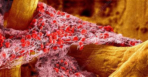 The american blood clot association is fighting every day to educate people on the signs and symptoms of blood clots. Blood clot, SEM - Stock Image - C019/4755 - Science Photo ...