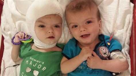 Conjoined Twins Jadon And Anias Formerly Conjoined Twins Return Home