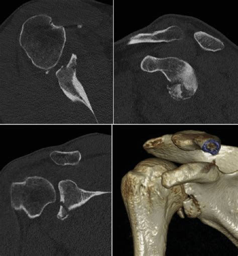 Preoperative Ct Scan And 3d Reconstruction 3d Three Dimensional Ct