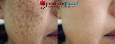 The Most Effective Way To Treat Melasma