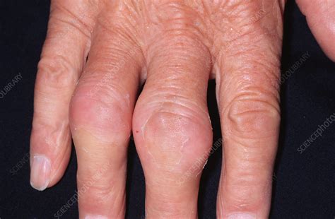 Gout Stock Image M Science Photo Library