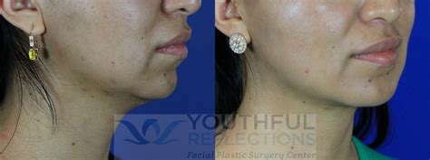 Chin Implant Before And After Photos Patient 107 Nashville Tn