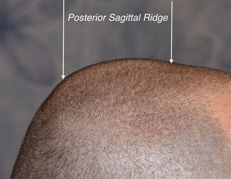 Technical Strategies Posterior Sagittal Ridge Skull Reduction