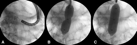 Management Of Transmesenteric Tunnel Jejunal Strictures With Endoscopic