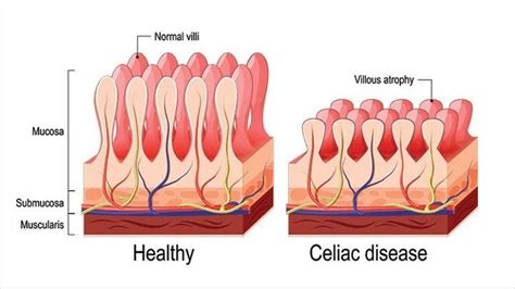 Stroke And Celiac Disease Stroke Manual