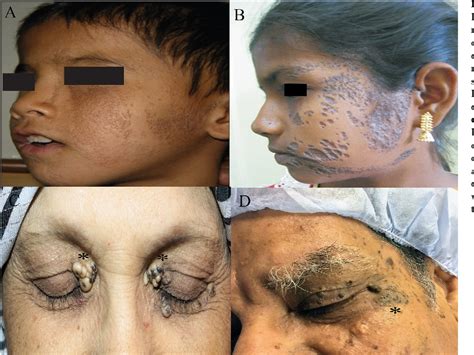 Figure 1 From Bilateral Nevus Comedonicus Of The Eyelids An Unusual