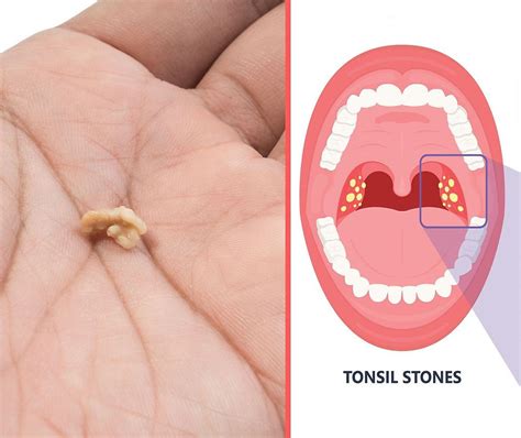 What are Tonsil Stones?