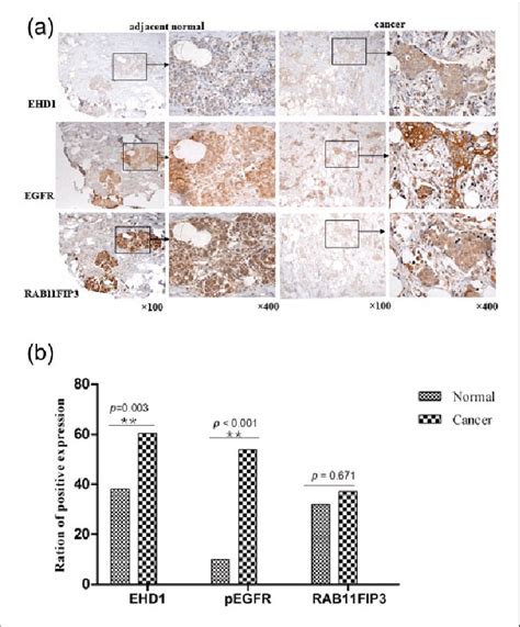 A Ihc Analysis Of Protein Expression In Cancer Tissues And Adjacent Download Scientific
