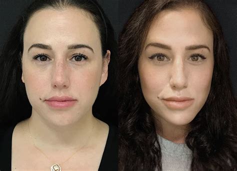 Cheek Fillers Before And After Realself Before And After