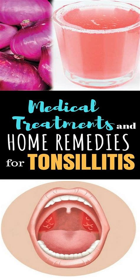 Medical Treatments And Home Remedies For Tonsillitis Healthy 4