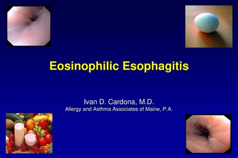Eosinophilic Esophagitis Ppt Download