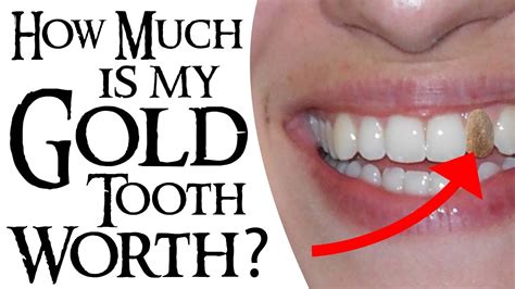 How Much Is My Gold Tooth Worth Youtube