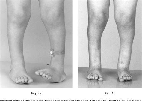 Figure 5 From Supramalleolar Derotation Osteotomy Of The Tibia With T