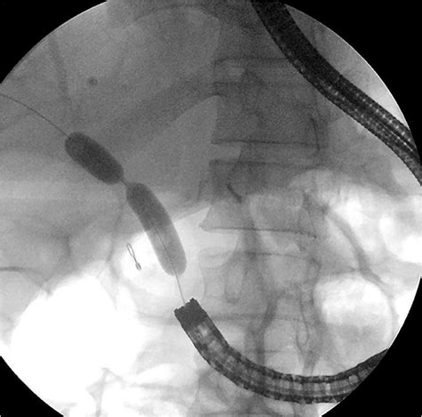 Biliary Stricture Treated Endoscopically With Balloon Dilation Followed