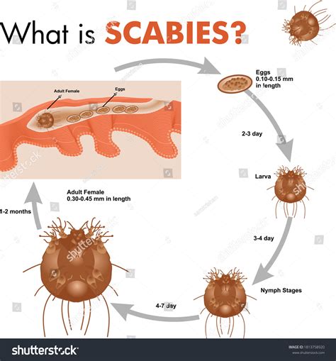 What Sexually Transmitted Disease Infographics Illustration Stock Vector Royalty Free 1813758920