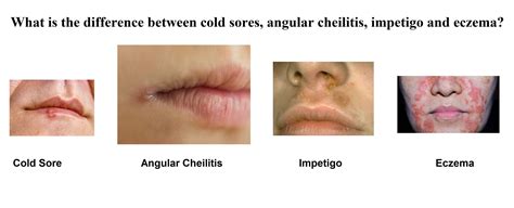 Angular Cheilitis Or Cold Sore