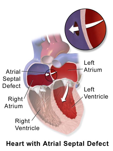 Pediatric Atrial Septal Defects — Classification And Surgery Lecturio