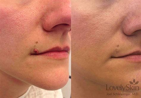Skin Lesion Mole Removal Before After Photos Seattle