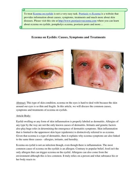 Eczema On Eyelids Causes Symptoms And Treatments