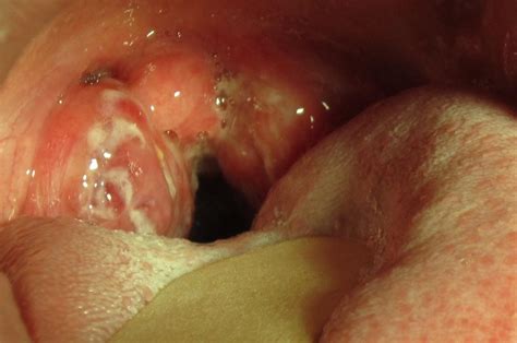 Strep Throat Tonsil Stones The Letter Of Introduction
