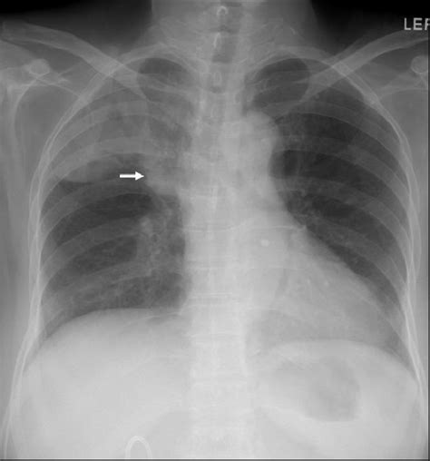 Preoperative Chest Pa Diffuse Haziness On The Right Upper Lung Field