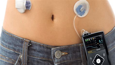 Wearables And New Tech For Diabetes Treatment