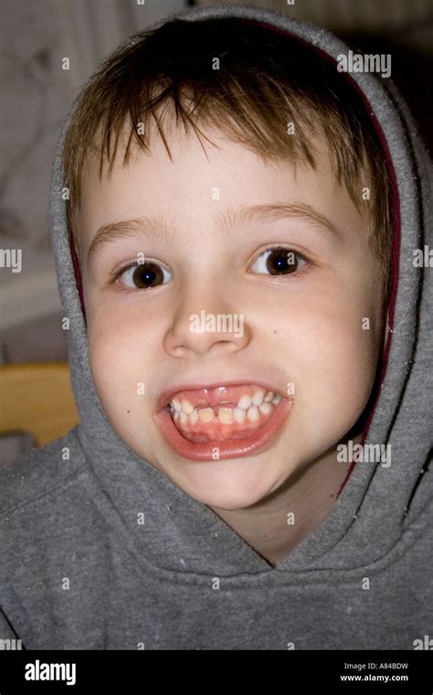 Boy Age 7 Missing Two Front Teeth St Paul Minnesota Usa Stock Photo
