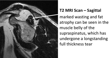 Fig 11 A Fat Atrophy Cambridge Shoulder