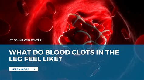 What Do Blood Clots In The Leg Feel Like St Johns Vein Center