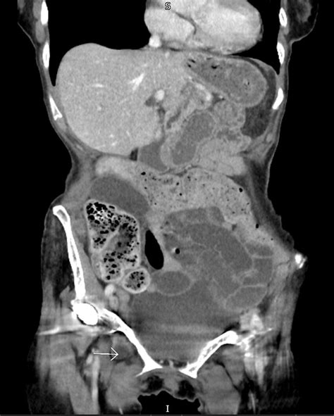 Ct Scan Of Abdomen And Pelvis Coronal Plane Showing The Right Sided
