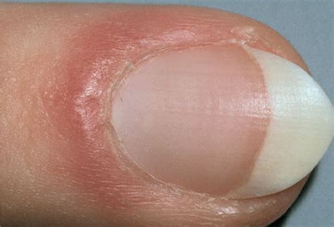 The skin under my nails keeps peeling and it's painful ... Shop with confidence on ebay!