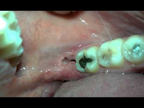 Luckily, there are a number of ways to make falling asleep after getting your wisdom teeth removed an easy and safe process with minimal discomfort. Wisdom tooth extraction site day 5, normal? - YouTube