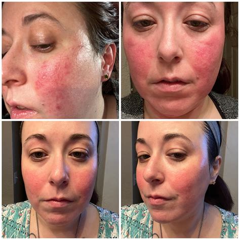 My Three Month Rosacea Journey With Prescription Topicals And Otc Products Metronidazole 75