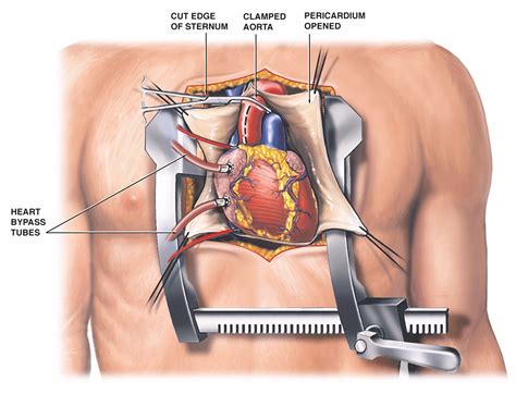 Tavr Procedure For Aortic Heart Valve Replacement Myval™ — Meril Life