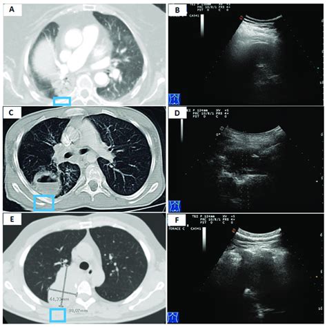 A Axial Chest Computed Tomography Ct Showing A Subpleural Pulmonary Download Scientific