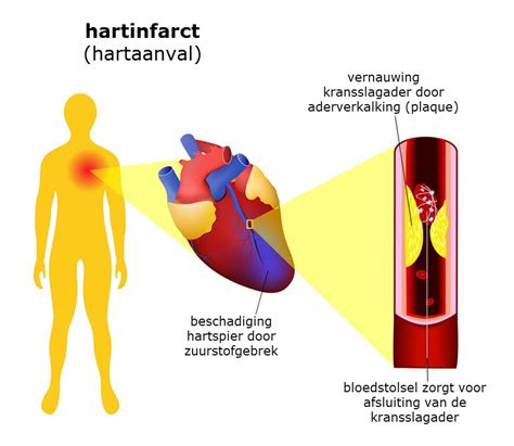 Wat Is Het Verschil Tussen Een Hartinfarct En Een Hartstilstand