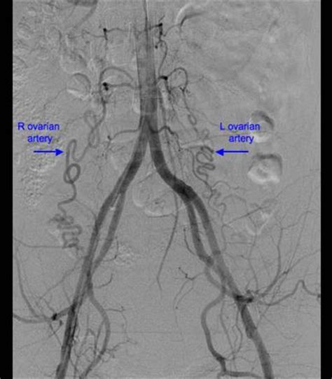 This article will outline the naming, distribution, and clinical there are two main coronary arteries which branch to supply the entire heart. Ovarian artery on angiography | Image | Radiopaedia.org