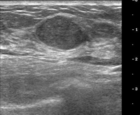 Ultrasound Image Of Left Breast Taken 2 Years After Ori Open I