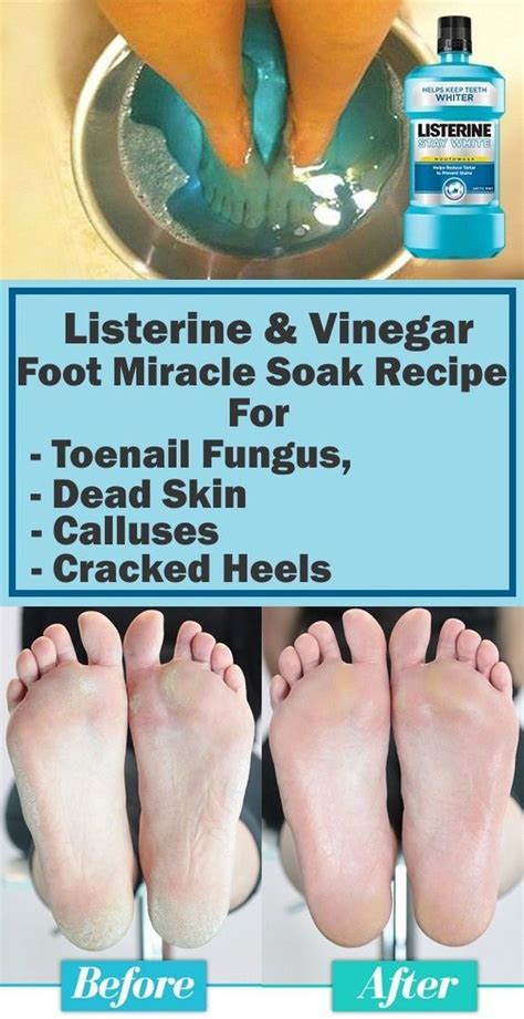 Listerine And Vinegar Foot Miracle Soak Recipe For Toenail Fungus Dead
